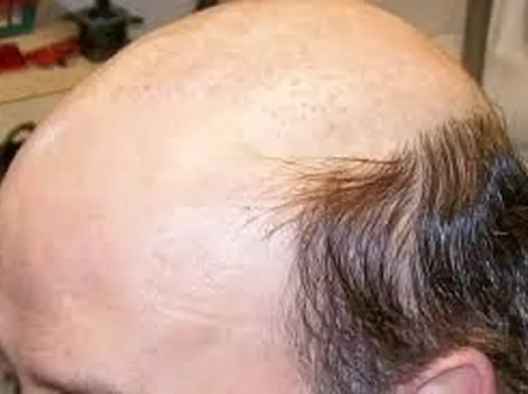 Fenomeno di alopecia