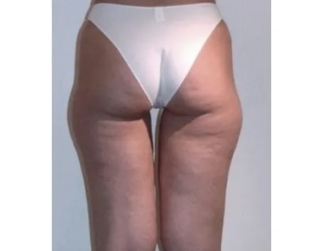cellulite