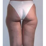 cellulite