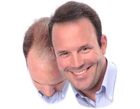 capelli calvizie 