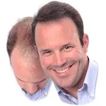 capelli calvizie 