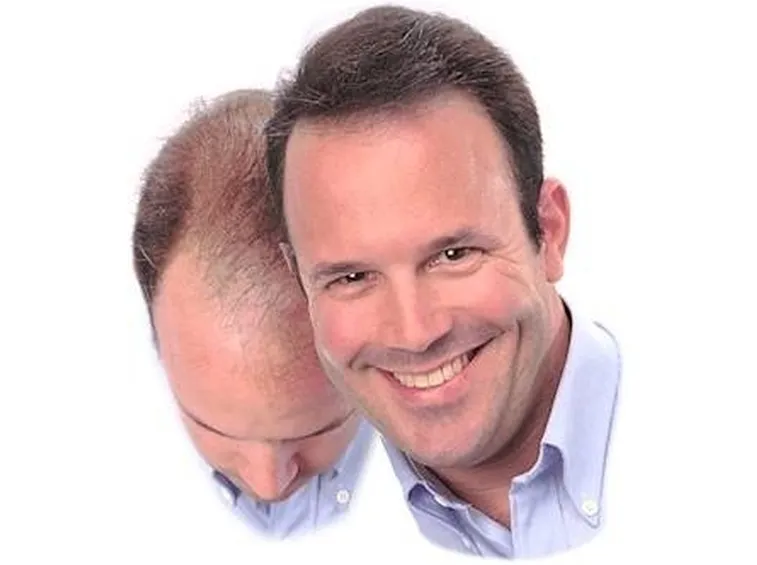 capelli calvizie 