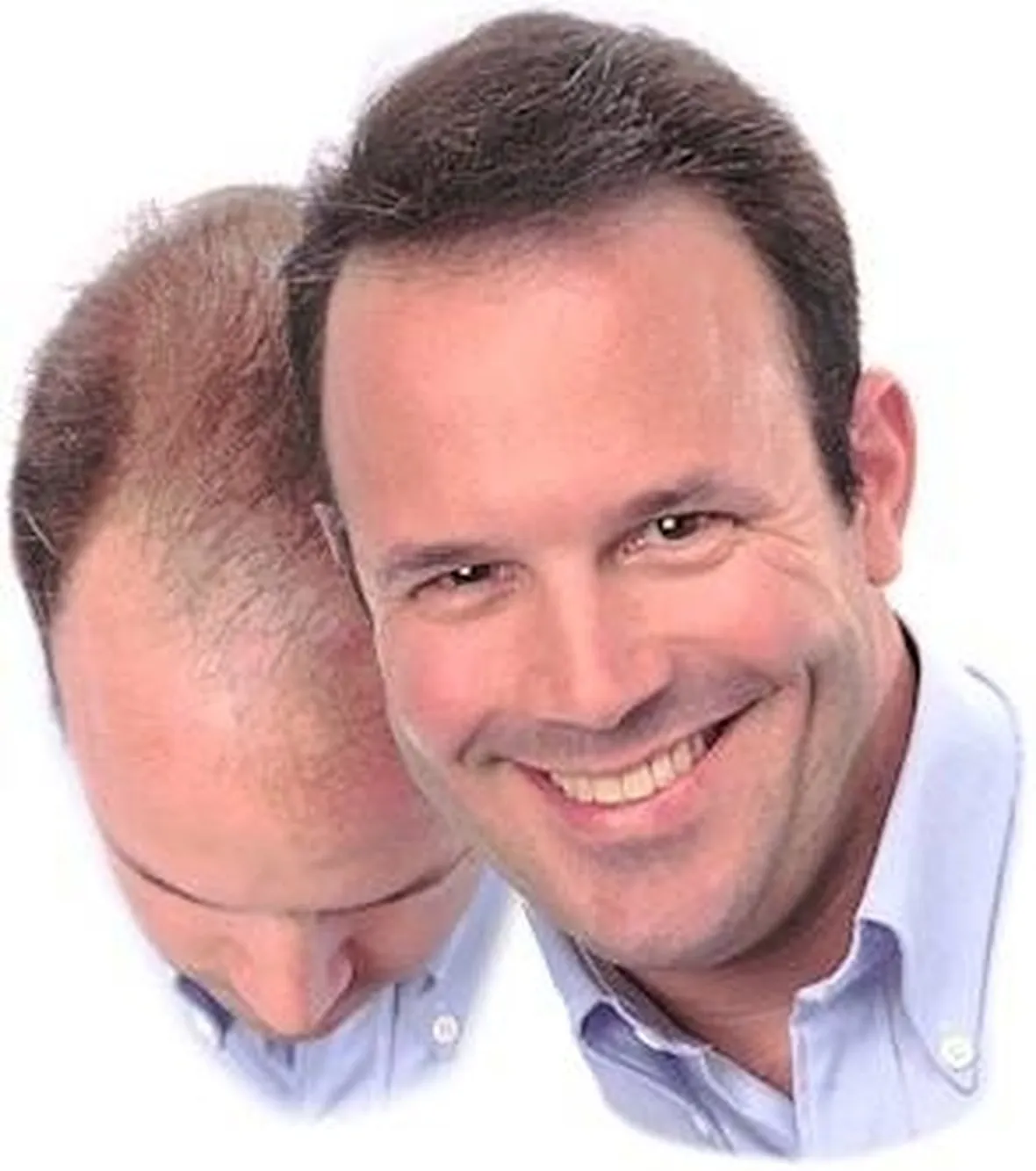 capelli calvizie 