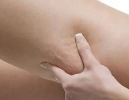 cellulite
