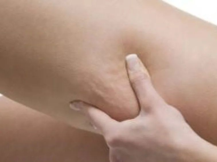 cellulite