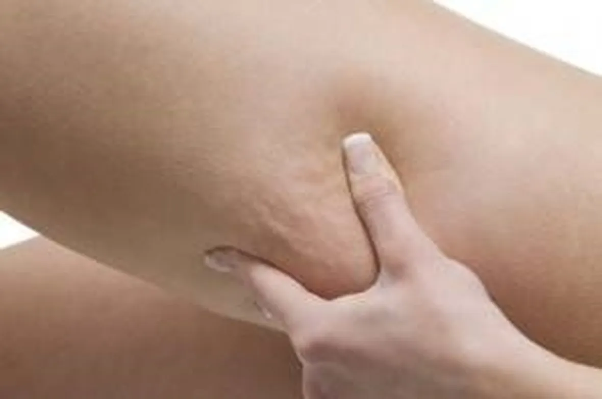 cellulite
